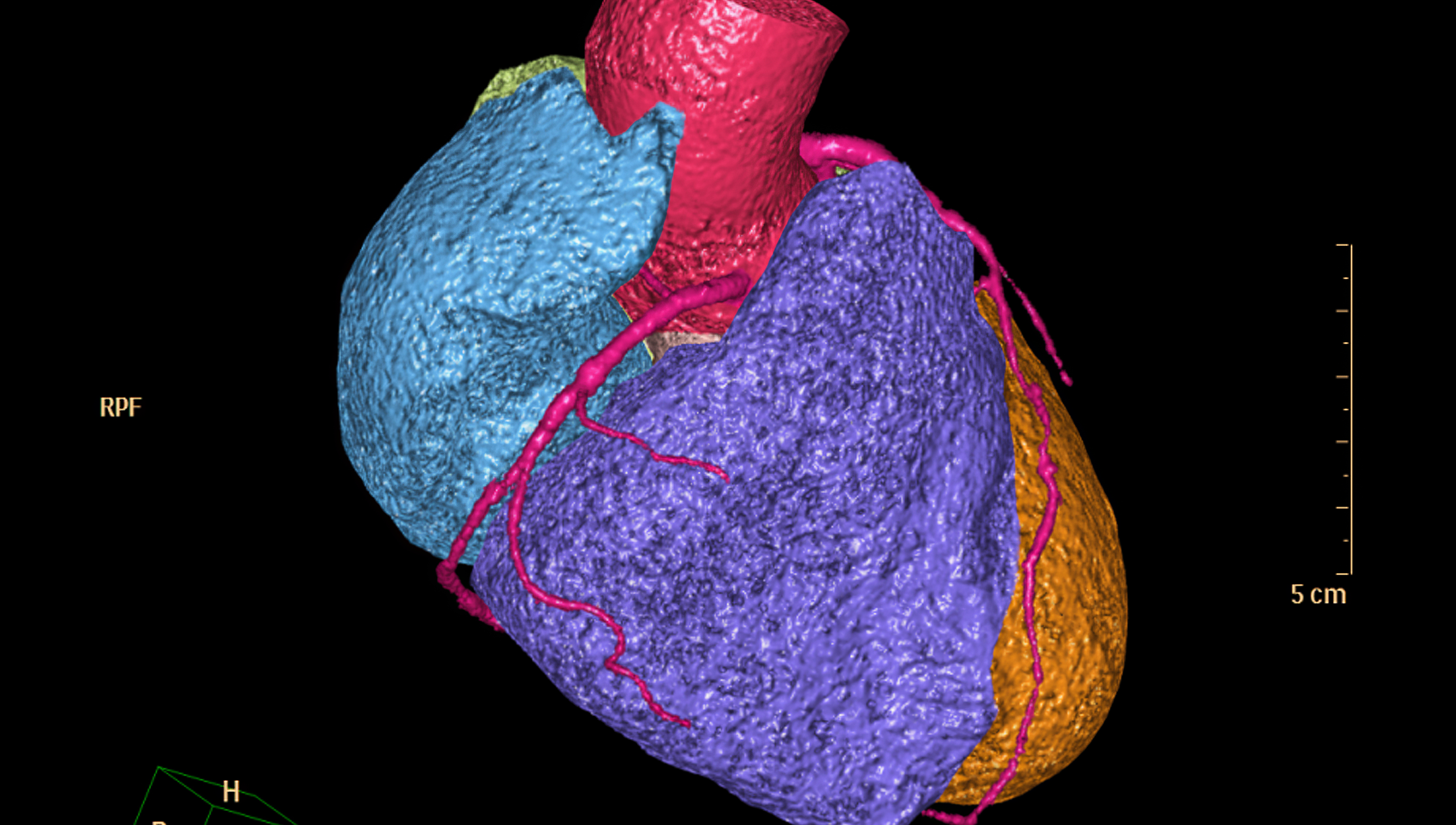 CTA Coronary artery image for detecting coronary artery disease