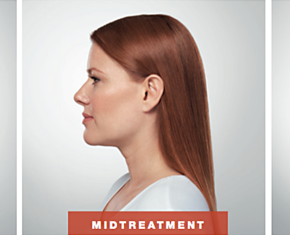 woman before, during, and after kybella treatment