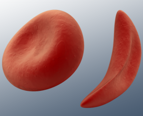 Illustration of enlarged view of regular cell and a sickle cell